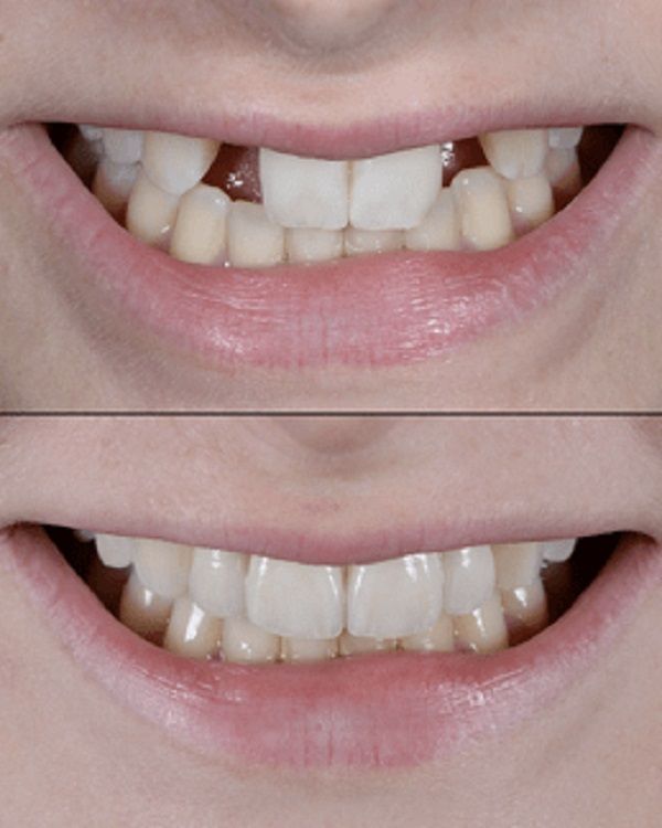 Proceso de implantes dentales